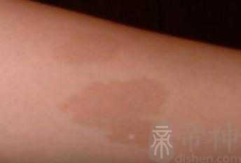 红色胎记民间说法 哪里有胎记是富贵命