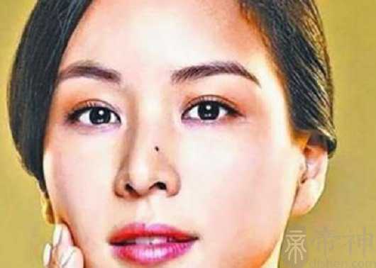 鼻梁上有痣代表什么,长了痣会如何