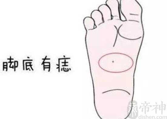 脚底长痣含义，脚底有痣，都代表富贵有权利
